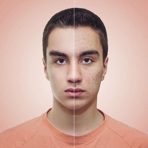 viso di adolescente prima e dopo cura dell'acne