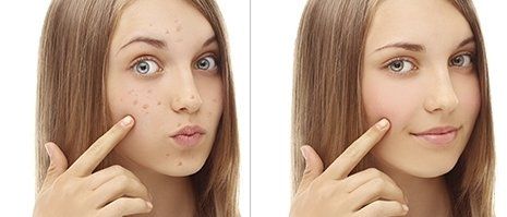 viso di donna prima e dopo cura dell'acne