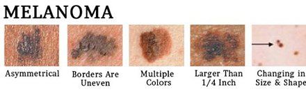 Mohs Skin Cancer 1