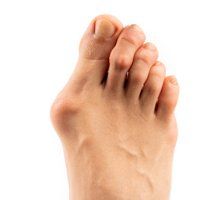 Foot With Bunion — Newport, RI — Newport Family Foot Care Foot With Bunion — Newport, RI — Newport Family Foot Care