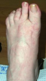 Foot After Six Months From Surgery — Newport, RI — Newport Family Foot Care Foot After Six Months From Surgery — Newport, RI — Newport Family Foot Care