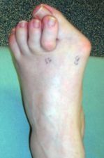 Before The Operation Of Their Patients — Newport, RI — Newport Family Foot Care Before The Operation Of Their Patients — Newport, RI — Newport Family Foot Care