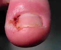 Ingrown Toenails — Newport, RI — Newport Family Foot Care Ingrown Toenails — Newport, RI — Newport Family Foot Care