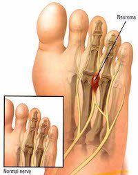 Nerve Tumor — Newport, RI — Newport Family Foot Care Nerve Tumor — Newport, RI — Newport Family Foot Care
