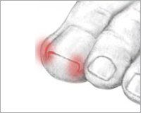 Foot For Nail Surgery — Newport, RI — Newport Family Foot Care
