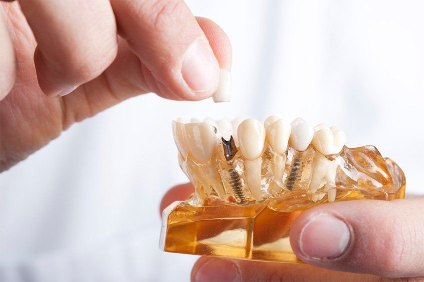 Close up image of Denture
