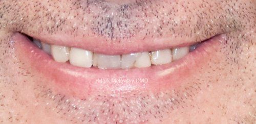 Close up photo of mans teeth before dental procedure