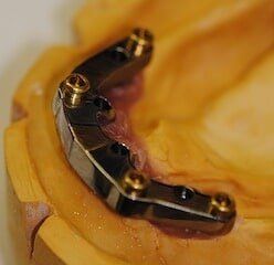 Implant Supported Dentures — Newport News, VA - Tidewater Prostho