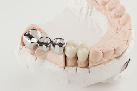 Bridged Dental Prostheses — Newport News, VA - Tidewater Prostho Bridged Dental Prostheses — Newport News, VA - Tidewater Prostho