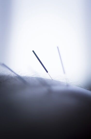 Dry Needling Acupuncture Needles — Muscle Pain Solutions in Hamilton, NSW