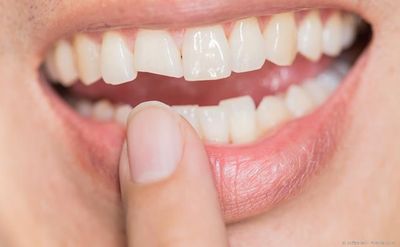Sog. Diastema: Angeborene Lücke zwischen den oberen mittleren Schneidezähnen Sog. Diastema: Angeborene Lücke zwischen den oberen mittleren Schneidezähnen