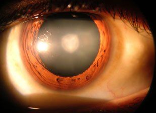 Best cataract surgery bangalore
