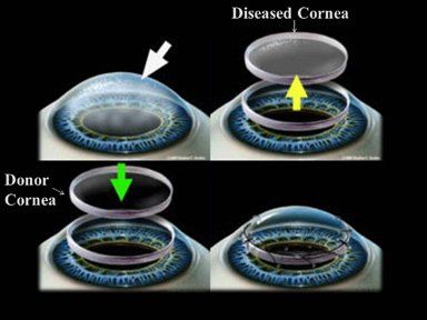 cornea eye hospital bangalore