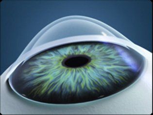 Best cornea surgery bangalore