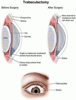 best hospital for glaucoma bangalore