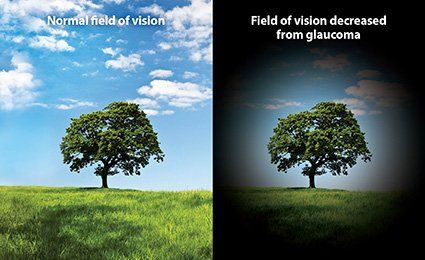 Best glaucoma care bangalore