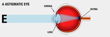 Best LASIK surgery bangalore