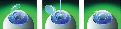 Best LASIK surgery bangalore