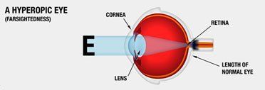 Best LASIK surgery bangalore