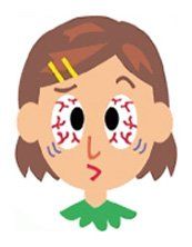 pediatric eye hospital bangalore