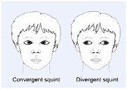 pediatric eye hospital bangalore