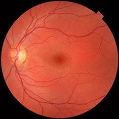 Best retina surgery bangalore