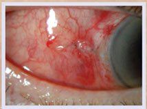 best retina surgeon bangalore