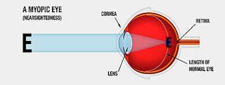 Best LASIK surgery bangalore