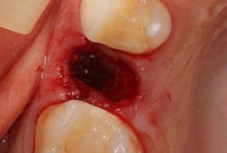 Implantologia dentale