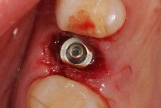 Implantologia dentale