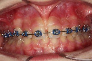 Frenulectomia con il laser