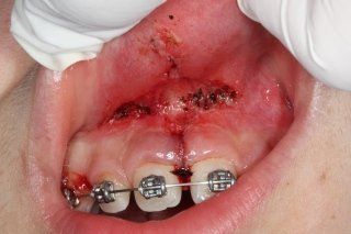 Frenulectomia con il laser