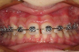 Frenulectomia con il laser