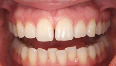 before invisalign 1