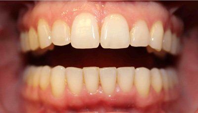 after invisalign 1