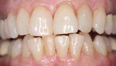 before invisalign 2