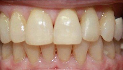 after invisalign 2