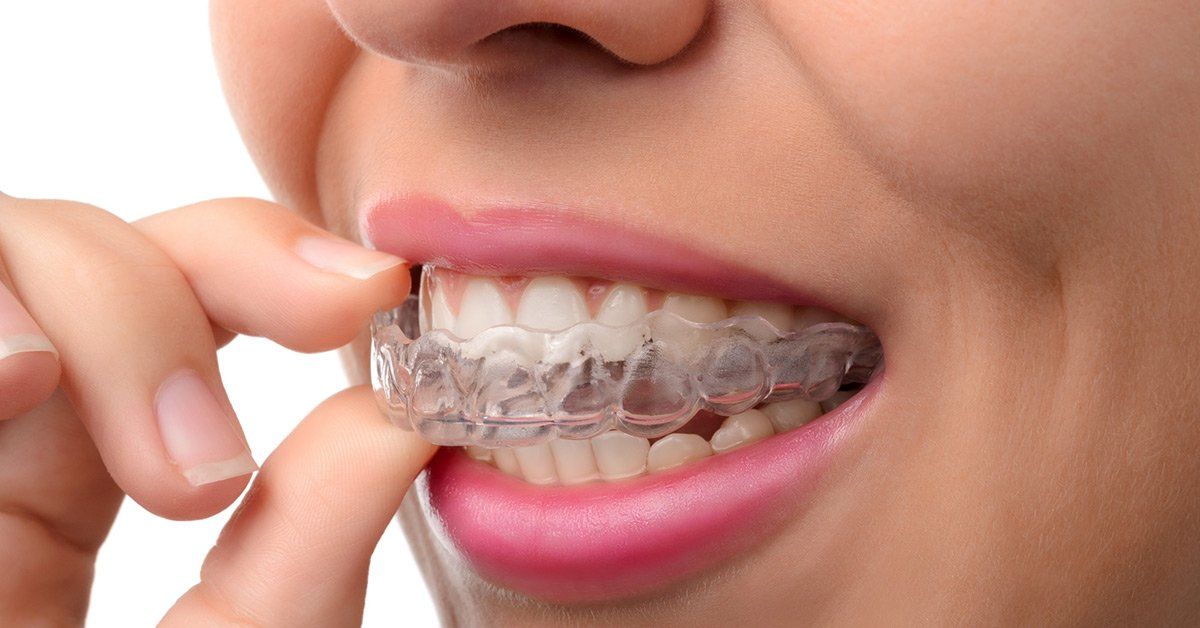 Dental Implant Steps