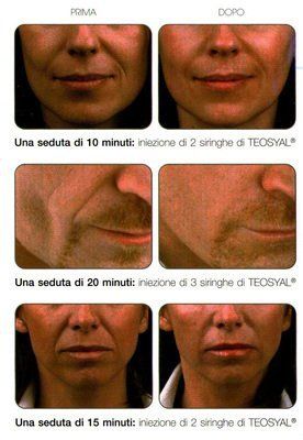 foto del prima e dopo l'iniezione di Teosyal