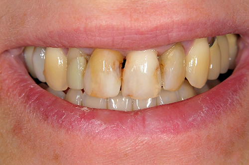 before full mouth reconstruction