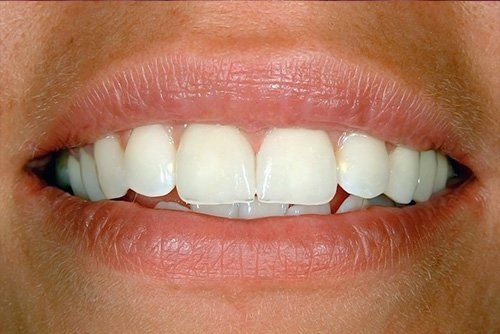 after dental veneers