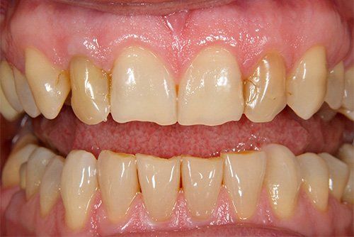before dental fillings