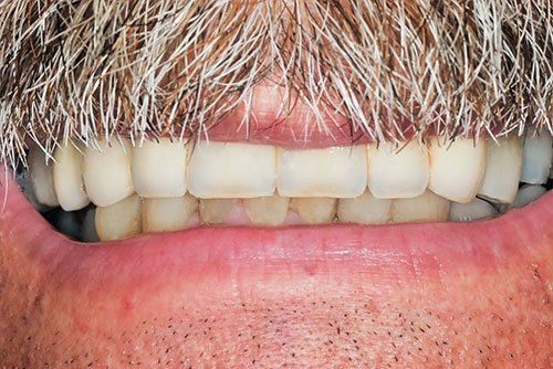 after dental bridge