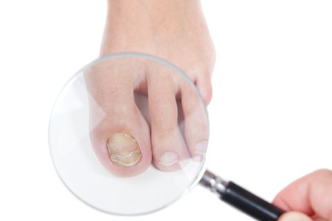 Toenail Fungus Treatment Tullahoma, TN Toenail Fungus Treatment