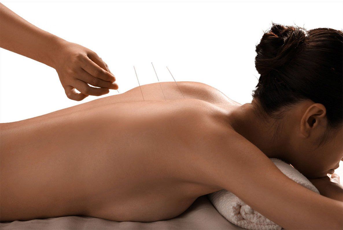 Acupunctuur