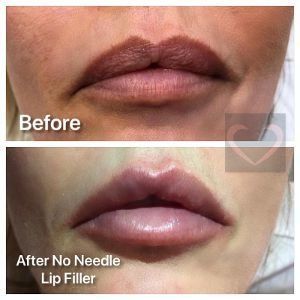 No Needle Filler Before & After