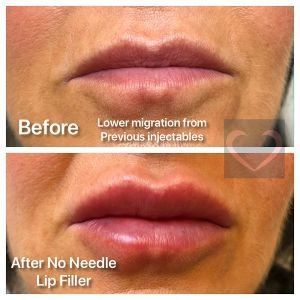 No Needle Filler Before & After
