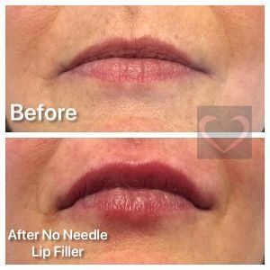 No Needle Filler Before & After