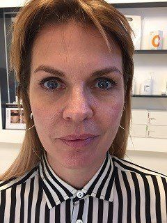 Before Treatment Photo
