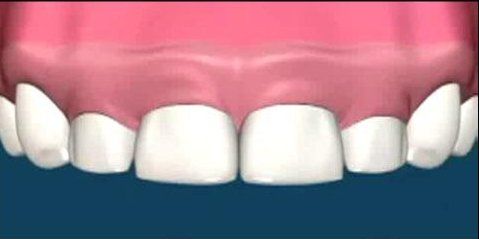 Gummysmile